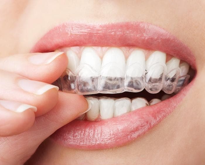 Fingers placing a clear aligner over the teeth
